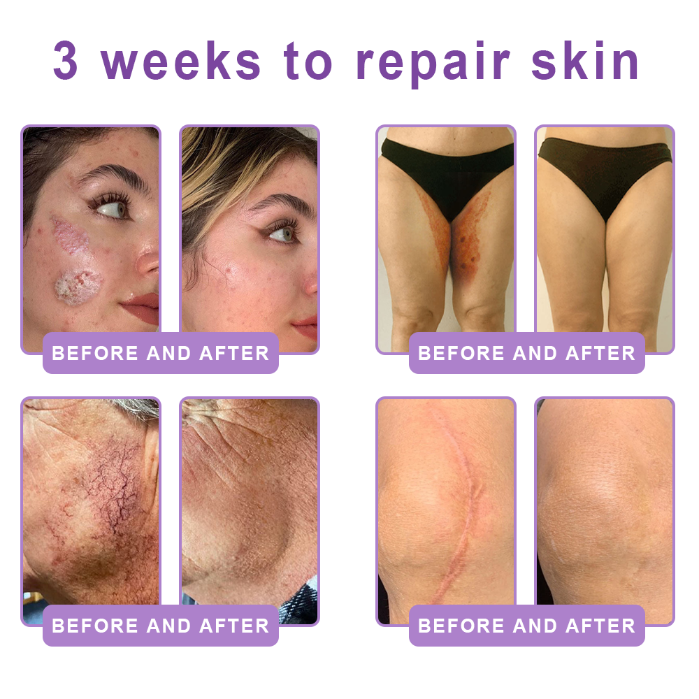 FDA Official: HISKIN® PDRN Multi-Peptide Massaging Body Roller Cream- Anti-aging, Hydrating, Skin Firming & Lifting, Skin Repair, Even Tone, Acne and Dark Spot Treatment, Wart and Mole Removal, and Psoriasis Relief.