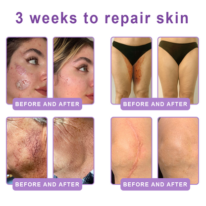 FDA Official: HISKIN® PDRN Multi-Peptide Massaging Body Roller Cream- Anti-aging, Hydrating, Skin Firming & Lifting, Skin Repair, Even Tone, Acne and Dark Spot Treatment, Wart and Mole Removal, and Psoriasis Relief.