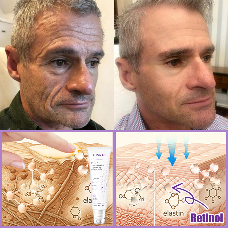 FDA Official: HISKIN® PDRN Multi-Peptide Massaging Body Roller Cream- Anti-aging, Hydrating, Skin Firming & Lifting, Skin Repair, Even Tone, Acne and Dark Spot Treatment, Wart and Mole Removal, and Psoriasis Relief.